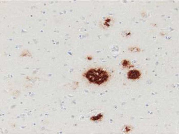 Human brain(Alzheimer's Disease)