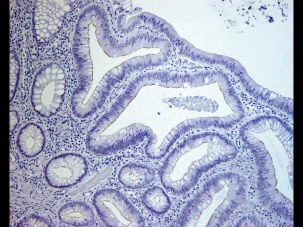 ヒト 大腸 tubular adenoma