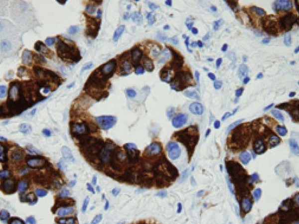 肺腺癌の浸潤部においても腫瘍細胞の胞体に陽性像が認められる