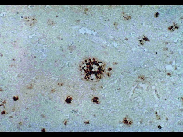 Human brain(Altzheimer's Disease)