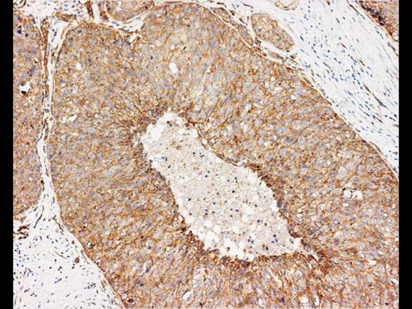 Basal-like breast carcinoma