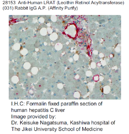 I.H.C: Formalin fixed paraffin section of human hepatitis C liver Image provided by: Dr. Keisuke Nagatsuma, Kashiwa hospital of The Jikei University School of Medicine